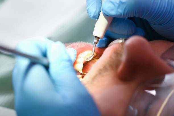 Best Urgent Care for Lost Fillings or Crowns in Meadow Vista, CA